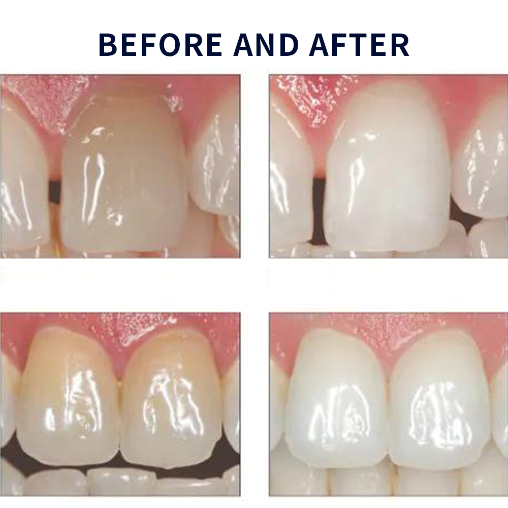 家庭用UV患者セット,プロの衛生機器,紫外線,16%,歯科材 - Teeth Whitening Kit のレビューと価格