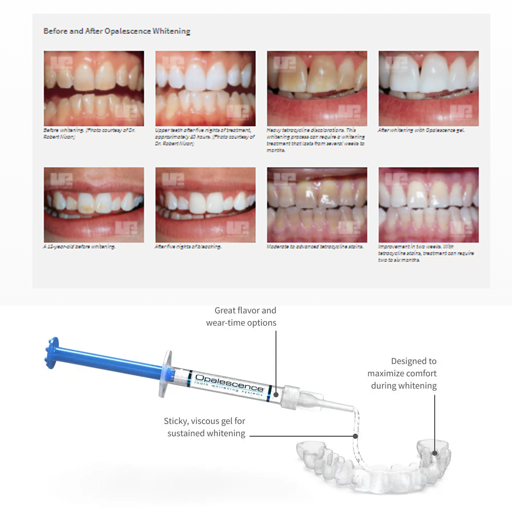 家庭用UV患者セット,プロの衛生機器,紫外線,16%,歯科材 - Teeth Whitening Kit のレビューと価格
